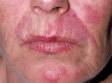 The dull red, scaling patches of discoid lupus are often circular or disc-shaped.