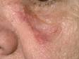 Circular dull, red spots that persist on the face are often the first sign of discoid lupus.