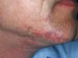 In discoid lupus erythematous, the skin can appear scarred with redness and scaling, as displayed in this image.