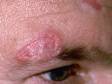 This image displays typical scarring due to discoid lupus erythematosus.