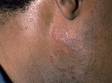 This image displays the ring-like, red, slightly elevated lesions typical of discoid lupus erythematosus.