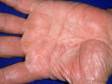 This image displays the rather unusual location of dyshidrotic dermatitis on the palms.