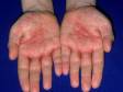 This image displays a severe example of dyshidrotic dermatitis on the palms.