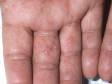 As displayed in this image, the blisters of dyshidrotic dermatitis are often difficult to see due to the thick skin of the palm and fingers.