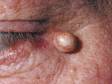 Epidermoid cysts are lined by skin cells that form a scale that accumulates in the cyst and appears as a creamy substance.