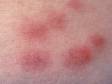 Erythema nodosum lesions are raised and tender when they begin (early lesions can be seen on the top part of this picture), but older lesions (seen on bottom part of the picture) flatten as they resolve.