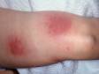 This image displays red, warm, tender lesions typical of erythema nodosum.