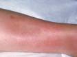 In erythema nodosum, the areas of skin involved are often red and warm to touch.
