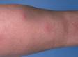 This image displays multiple red lesions on a leg, typical of erythema nodosum.