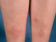 This image displays the red, elevated areas of the skin on the lower legs, typical of erythema nodosum.