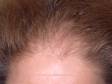 In female pattern alopecia (balding), there is often thinning at the front of the scalp.