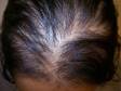 This is typical "female pattern" hair loss. Note the widening of the part and thinning that surrounds it, leading to a pattern that looks like an upside-down Christmas tree. Unlike for men, pattern baldness in women usually preserves the hairline. 