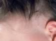 In female pattern alopecia (balding) the scalp is entirely normal but there is noticeable hair thinning.