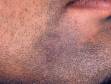 This image displays flat warts in a beard area, which are typically spread by shaving.