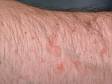 Flat warts can appear pink and sometimes broad in shape, as displayed in this image.
