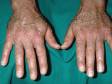 This image displays a severe case of flat warts on the hands, including dozens of white-appearing lesions.