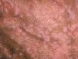 Flat warts are common on the face, arms, and legs and can be spread by scratching and shaving.