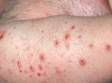 This image displays small pus-filled lesions of folliculitis that have dried up and been scratched.