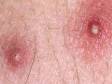 These are the pus-filled lesions typically seen in folliculitis.
