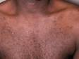 This image shows a typical case of folliculitis.