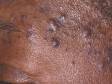The lesions of folliculitis may be pus-filled, signifying an infection.