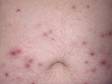 This image shows lesions of folliculitis in different stages of healing. The red bumps are newer and active, while the brown spots are older. 