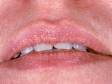 This image displays small yellow bumps on the oil glands of the upper lip typical of Fordyce spots.
