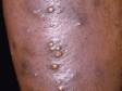 This person developed several furuncles (boils) and pustules on the leg.