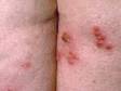 This image displays a grouping of blisters on the buttocks in a patient with herpes simplex.