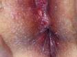 The small ulcer of herpes is seen between the vulva (upper area of the image) and the rectum (lower area of the image).