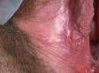 This image displays small blisters of a herpes infection (toward the bottom of the picture).