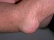 Gout often results in nodules called tophi; this image shows an affected elbow.