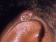 The rim of this man's ear has an ulcer due to a gouty tophus.