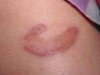 The typical lesions of granuloma annulare are ring-like, brownish-red, and slightly elevated lesions.
