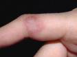 The herpes simplex virus infection on the finger is known as herpetic whitlow. Grouped, fluid-filled or pus-filled, blisters are typical and usually itch and/or are painful.