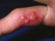 Herpetic whitlow is the term for herpes infection of the finger, which includes clustered blisters or pus-filled lesions.