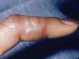 This image displays blisters on a finger typical of a herpes simplex infection.