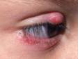 A chalazion/stye can occur at the eyelid edge.