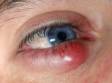 This large chalazion is most likely painful and must be treated vigorously to avoid developing bacterial complications.