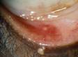 A cheese-like (sebaceous) discharge from the chalazion is often seen, especially after applying hot compresses.