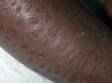 Ichthyosis vulgaris ("fish skin") results in severe dryness of the skin causing flaking and scaling, as displayed in this image.