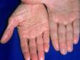 This image displays the contrast between the dry, shiny skin of a person with ichthyosis (left) and the skin of an unaffected person's hand (right).