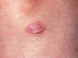 This image displays a pus-filled lesion with crust due to a impetigo, a superficial skin infection from either strep or staph bacteria.