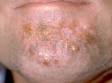 This image displays honey-colored crusts in the beard area, typical of impetigo.