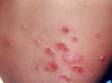 This image displays intact blisters and crusted erosions showing the spectrum of skin lesions typical of impetigo.