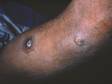 This image displays thick scaling, crusts, and erosions of the skin surface typical of impetigo.