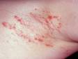 Intertrigo (irritation of body fold areas) may be displayed as irregular red patches and bumps.