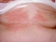 Irritant contact dermatitis from friction.