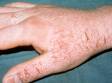 This image displays scaly, red, cracked skin typical of irritant dermatitis.