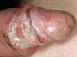 Excessive friction can cause a breakdown (irritant contact dermatitis) of the fragile genital skin.